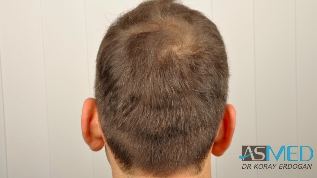 norwood4 2600-grafts-FUE-3 e6877507