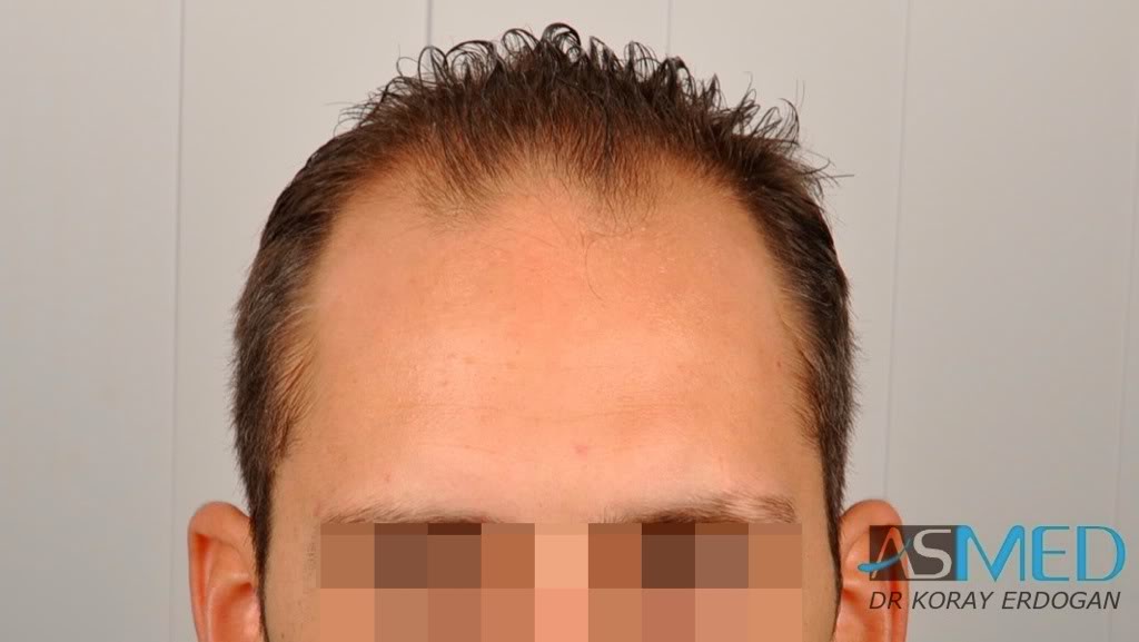 norwood4 2600-grafts-FUE-3 f1d76f5c