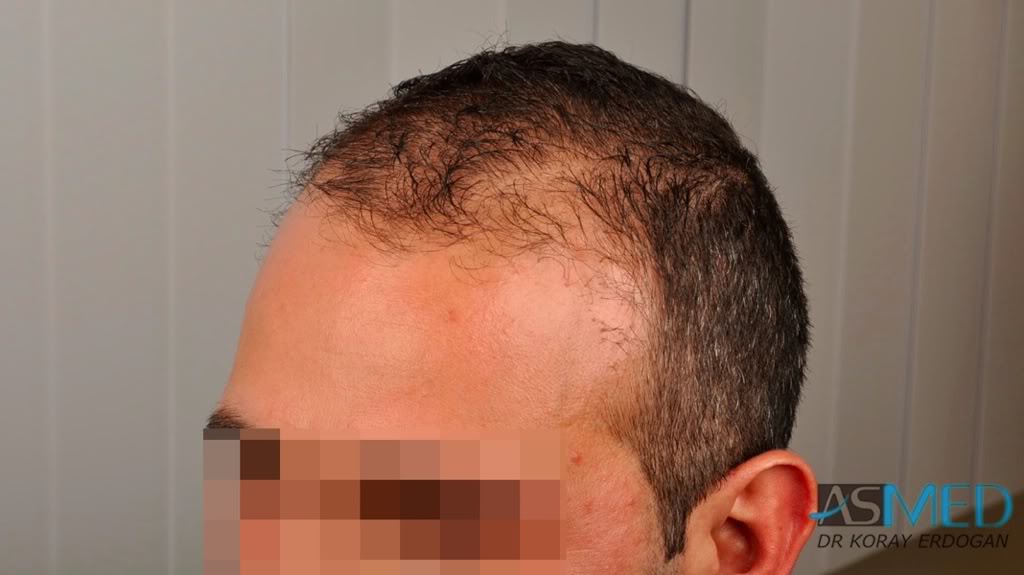 norwood4 2620-grafts-FUE 09e1ce4a