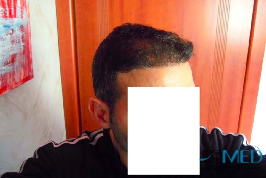 norwood4 2620-grafts-FUE 21e9cd48