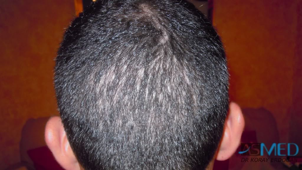 norwood4 2620-grafts-FUE 386f67be