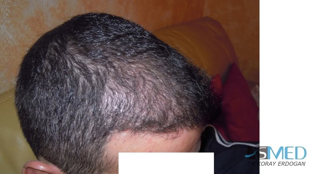 norwood4 2620-grafts-FUE 38cb3c0b