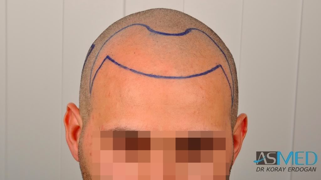 norwood4 2620-grafts-FUE 3bf0655b