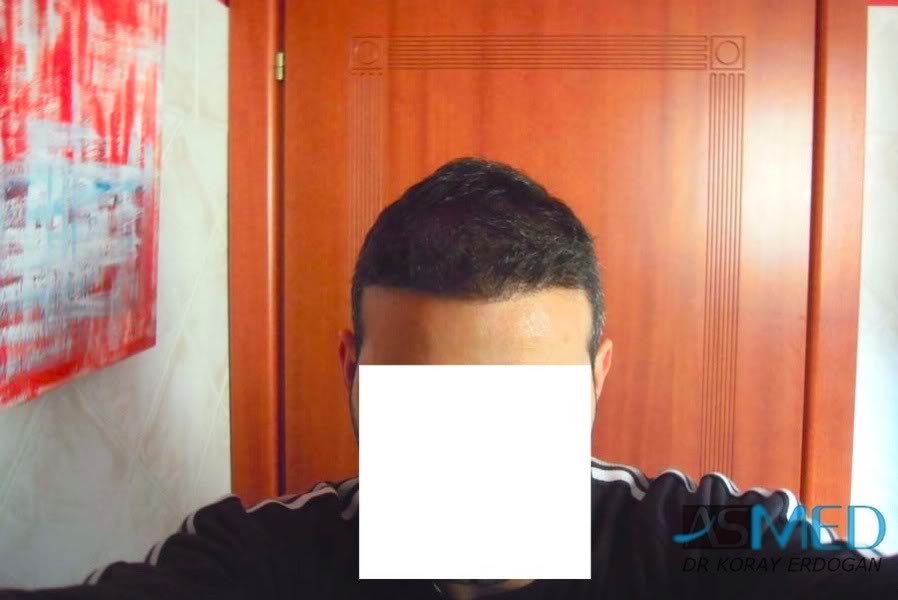norwood4 2620-grafts-FUE 3d0a0379