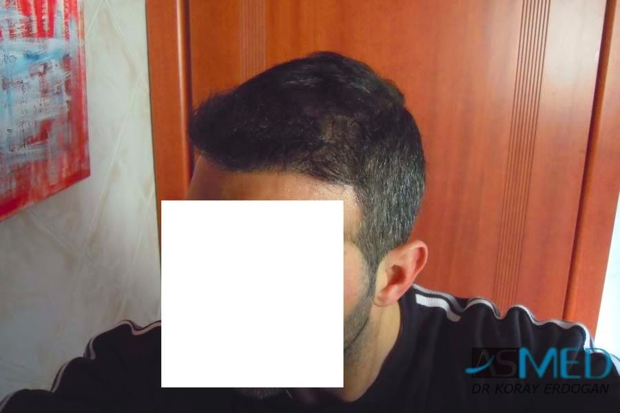 norwood4 2620-grafts-FUE 3fc512a8