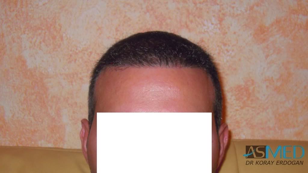 norwood4 2620-grafts-FUE 82a0775c