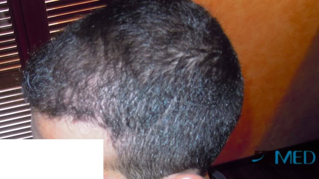 norwood4 2620-grafts-FUE 94bc265e