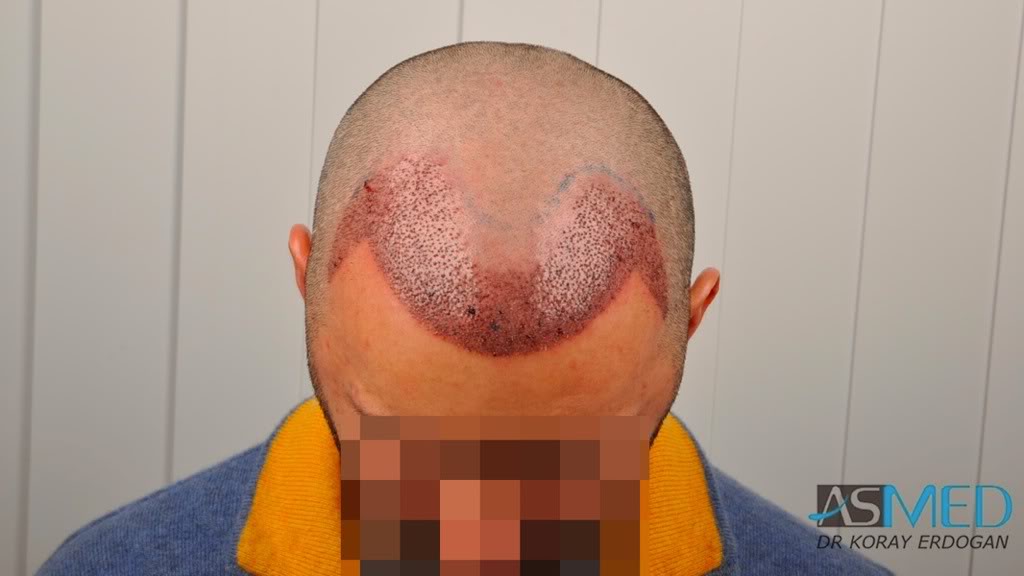 norwood4 2620-grafts-FUE 99602c47