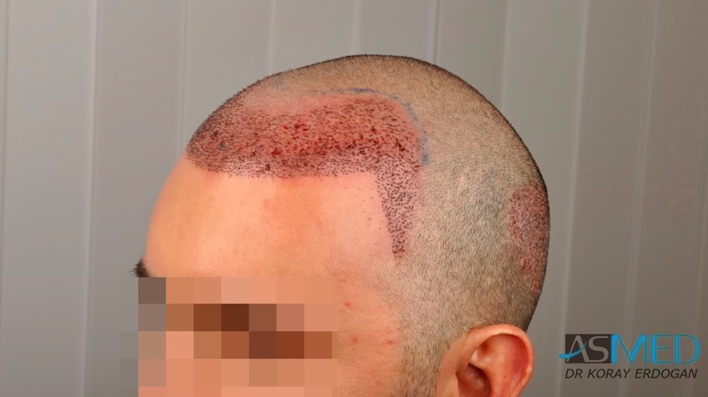 norwood4 2620-grafts-FUE a0dfa0ec