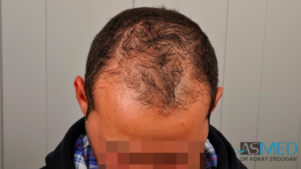 norwood4 2620-grafts-FUE dcf1146c