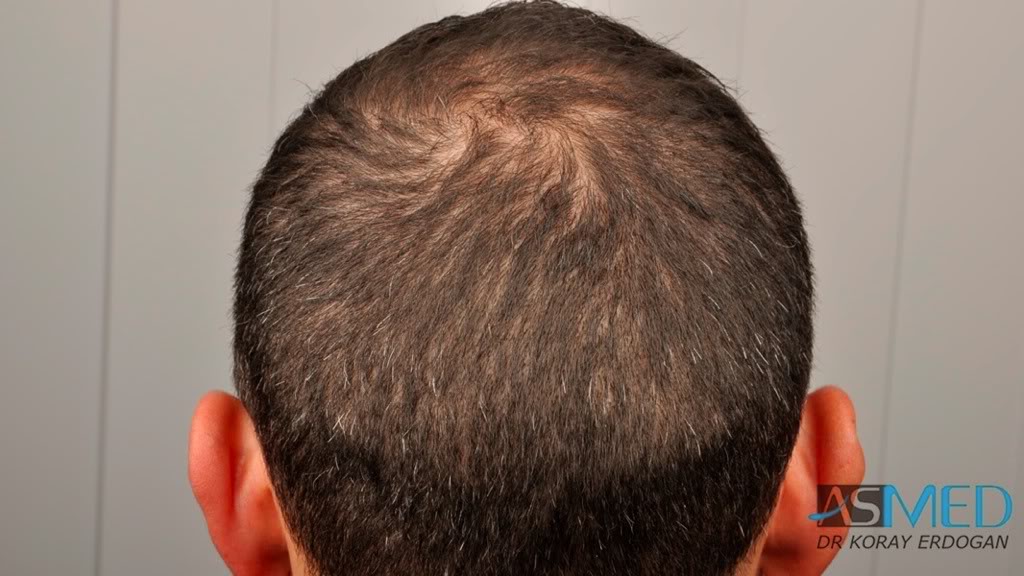 norwood4 2620-grafts-FUE f2c1e710