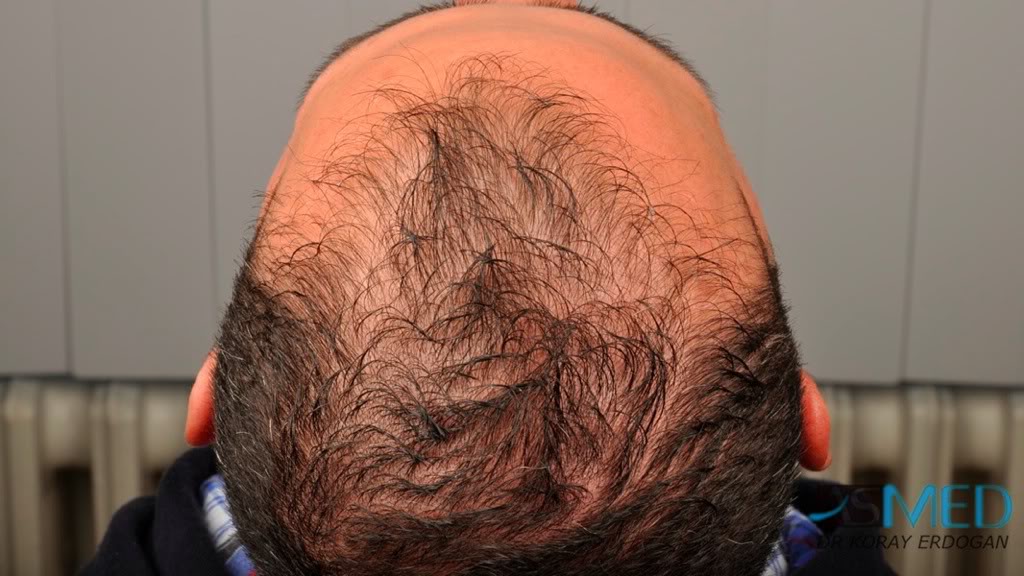 norwood4 2620-grafts-FUE f6fc1360