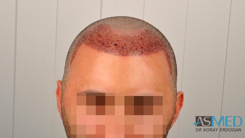 norwood4 2620-grafts-FUE fb442b57