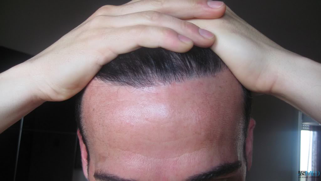 norwood4 2650-grafts-FUE 010d0c77