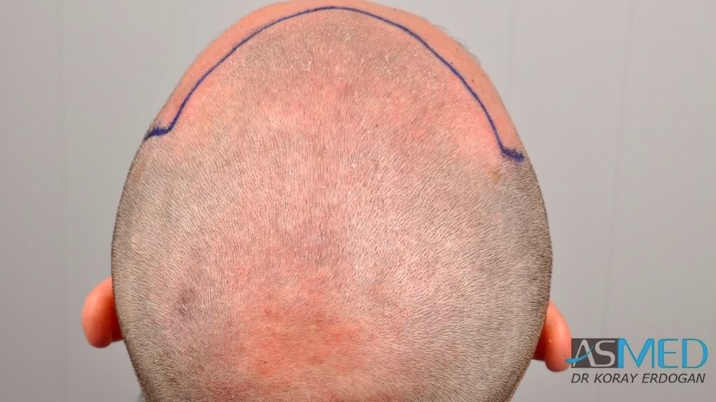 norwood4 2650-grafts-FUE 09c6a2c0