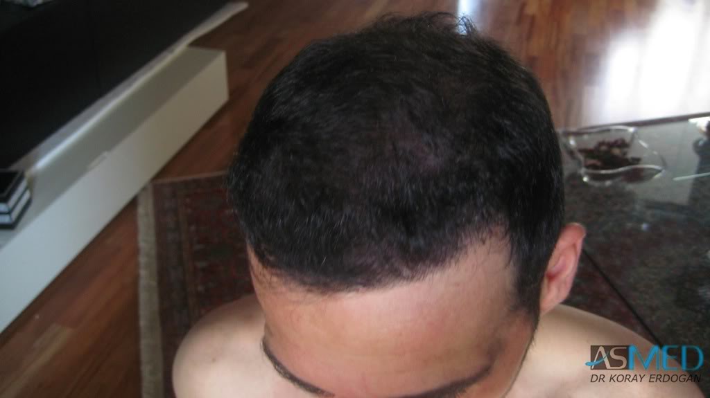 norwood4 2650-grafts-FUE 0e5c61f1