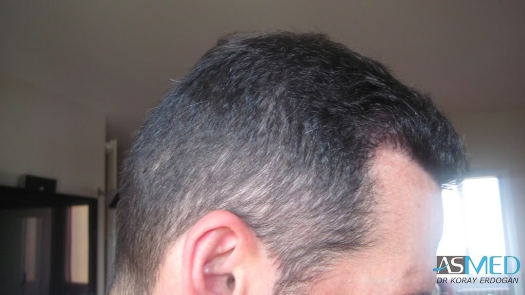 norwood4 2650-grafts-FUE 17c9b665