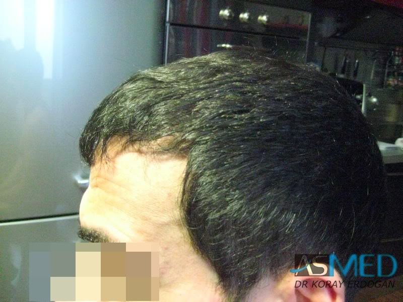 norwood4 2650-grafts-FUE 1dab45c0