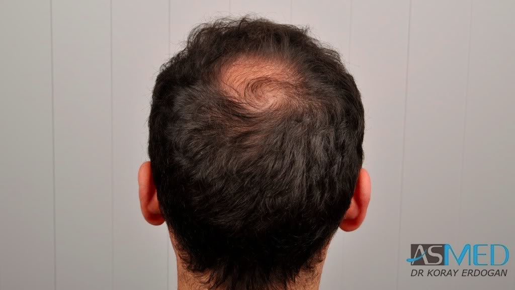 norwood4 2650-grafts-FUE 274e1655