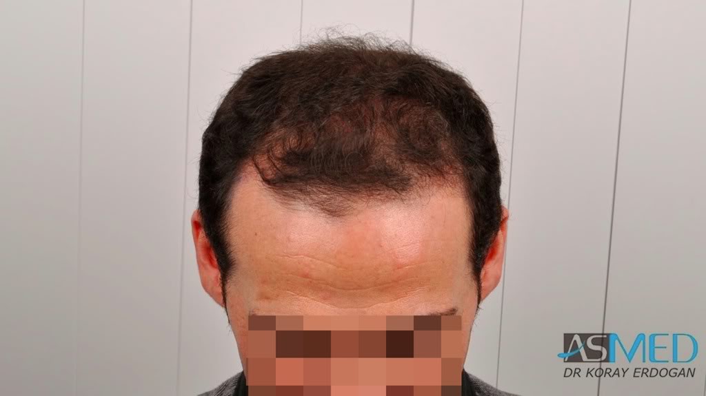 norwood4 2650-grafts-FUE 28b9d92b