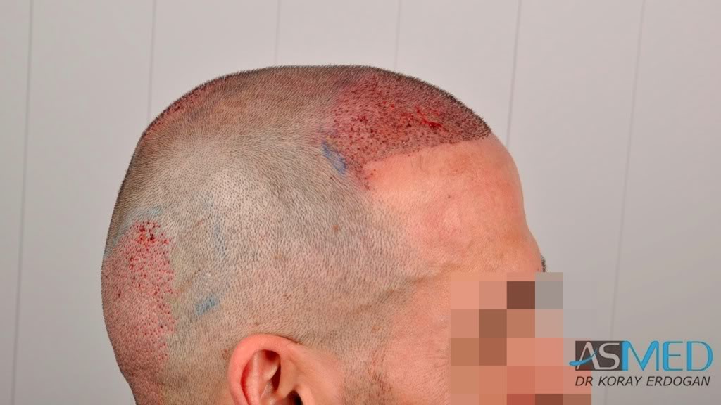norwood4 2650-grafts-FUE 2a9635d1