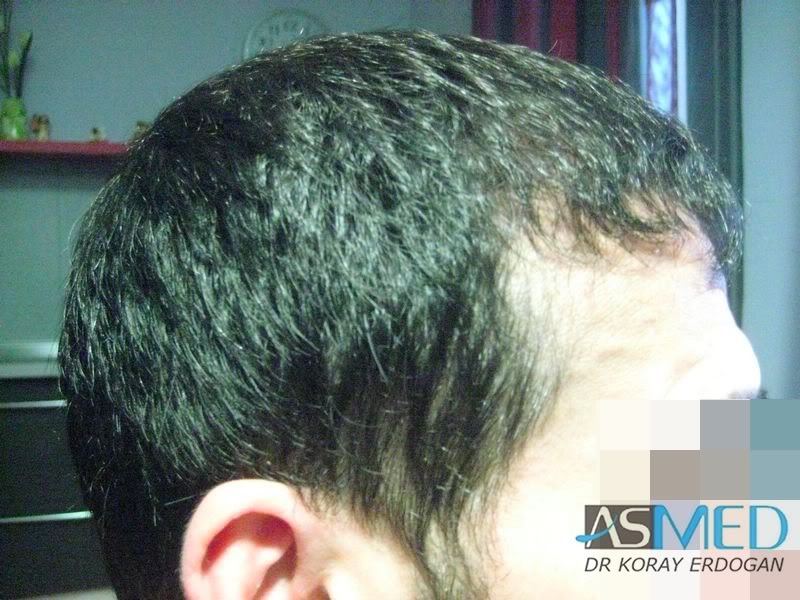 norwood4 2650-grafts-FUE 2b0a97d8