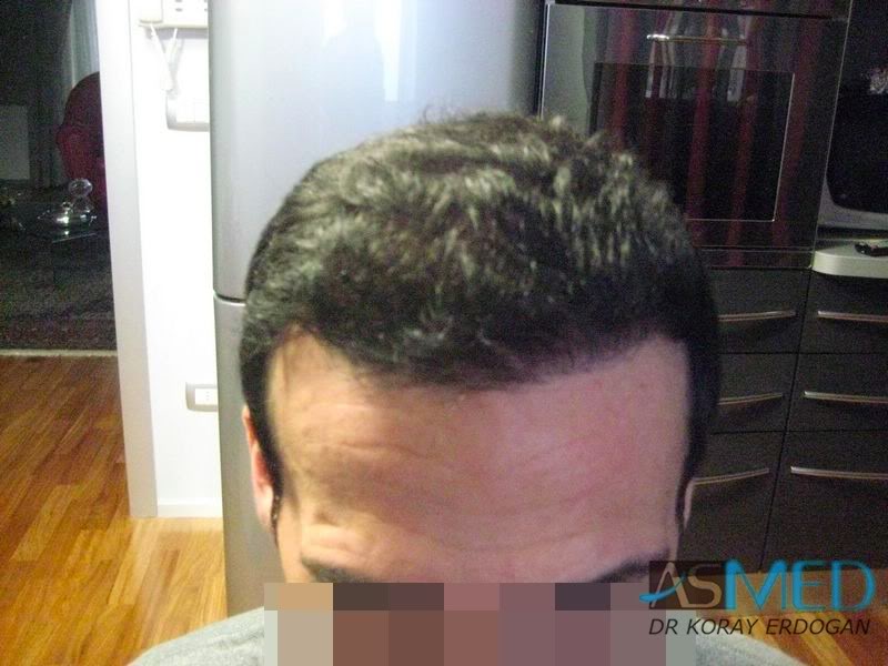 norwood4 2650-grafts-FUE 35e91476