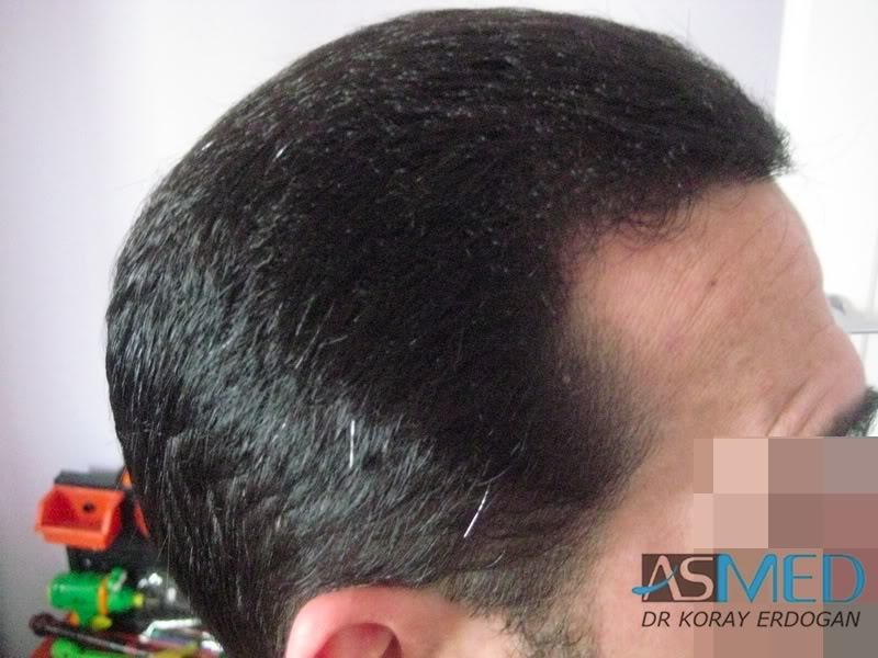 norwood4 2650-grafts-FUE 56896936
