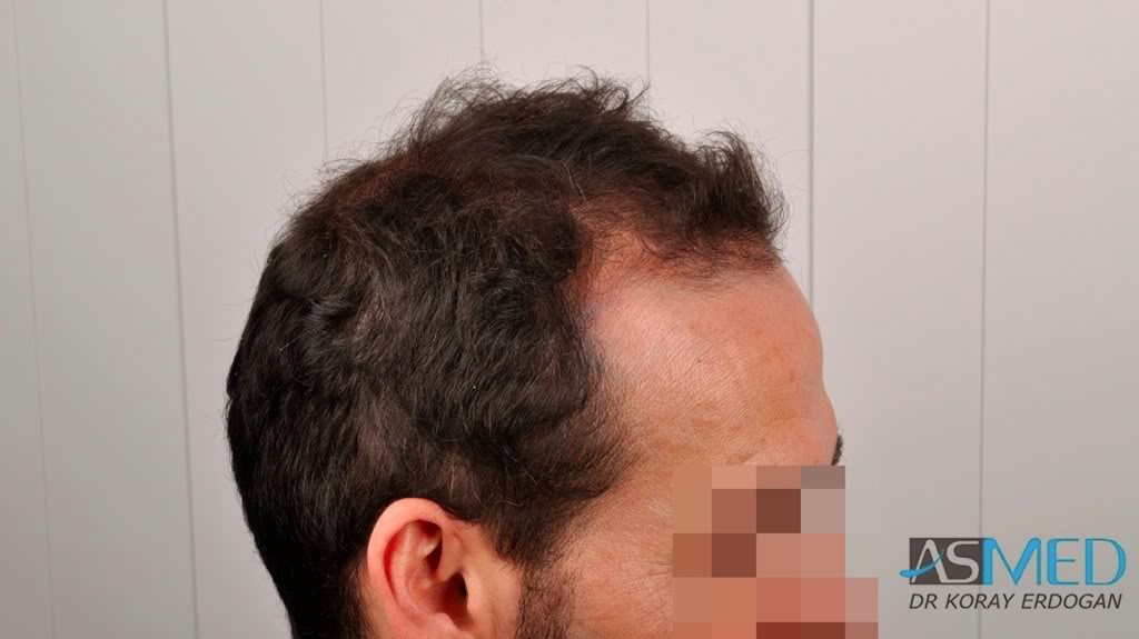 norwood4 2650-grafts-FUE 9390f60e