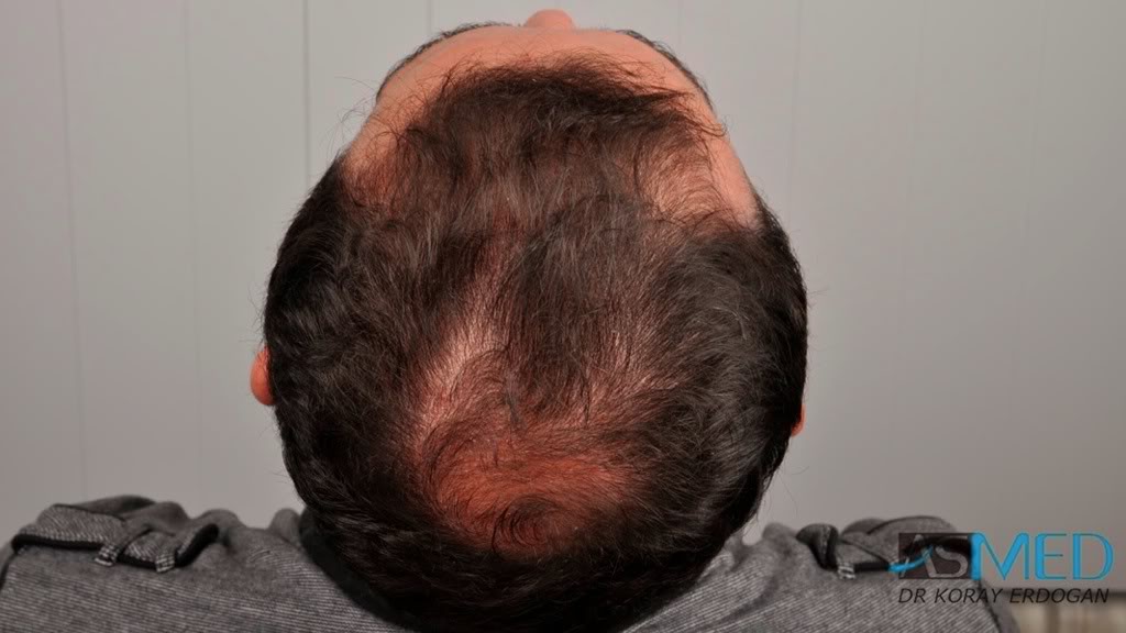 norwood4 2650-grafts-FUE 9f2430f7
