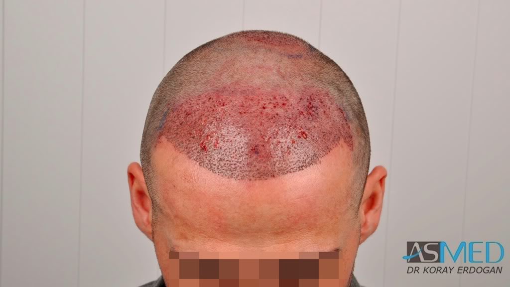 norwood4 2650-grafts-FUE a8828375