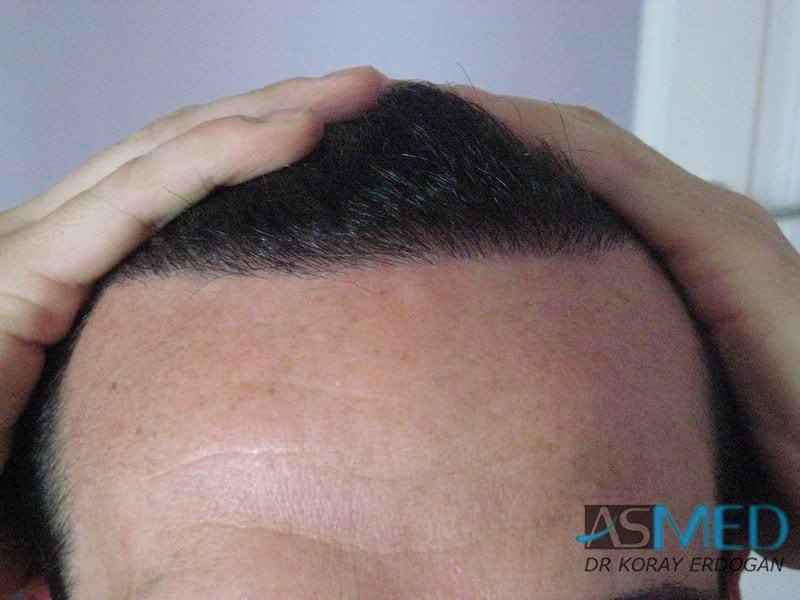norwood4 2650-grafts-FUE abbee3e5