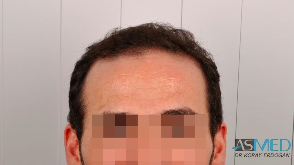 norwood4 2650-grafts-FUE bd0e40e5