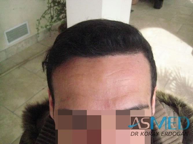 norwood4 2650-grafts-FUE bd723d96