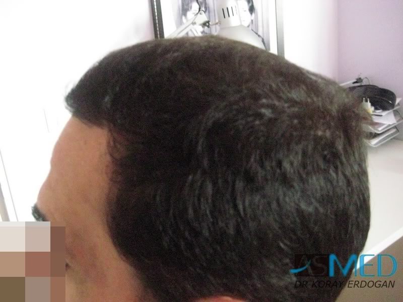 norwood4 2650-grafts-FUE de5fb7c1