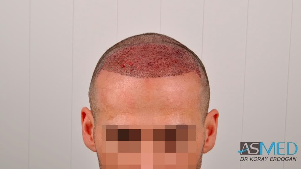 norwood4 2650-grafts-FUE f3f2487f