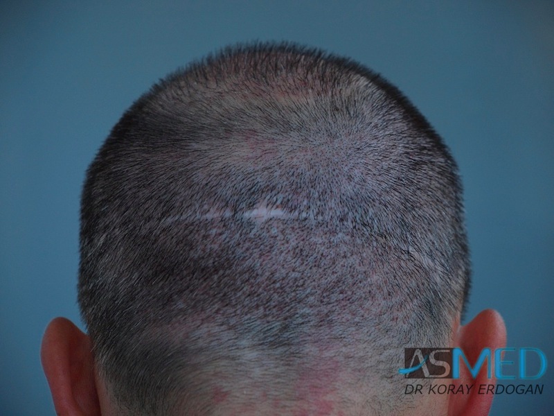 norwood4 3167-grafts-FUE-Repair file-17