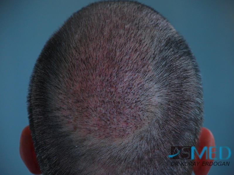 norwood4 3167-grafts-FUE-Repair file-18