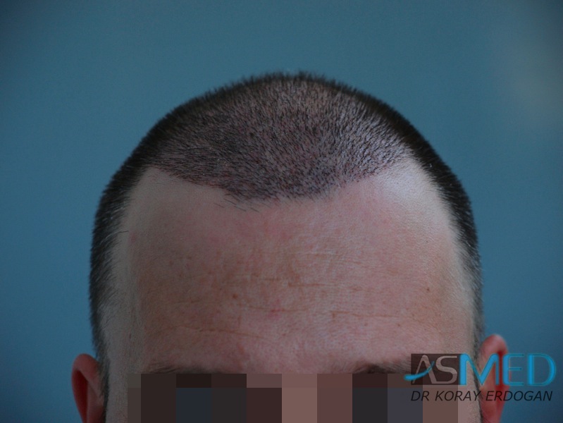 norwood4 3167-grafts-FUE-Repair file-19