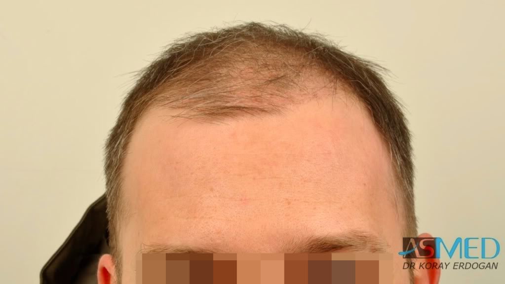 norwood4 3167-grafts-FUE-Repair file-27