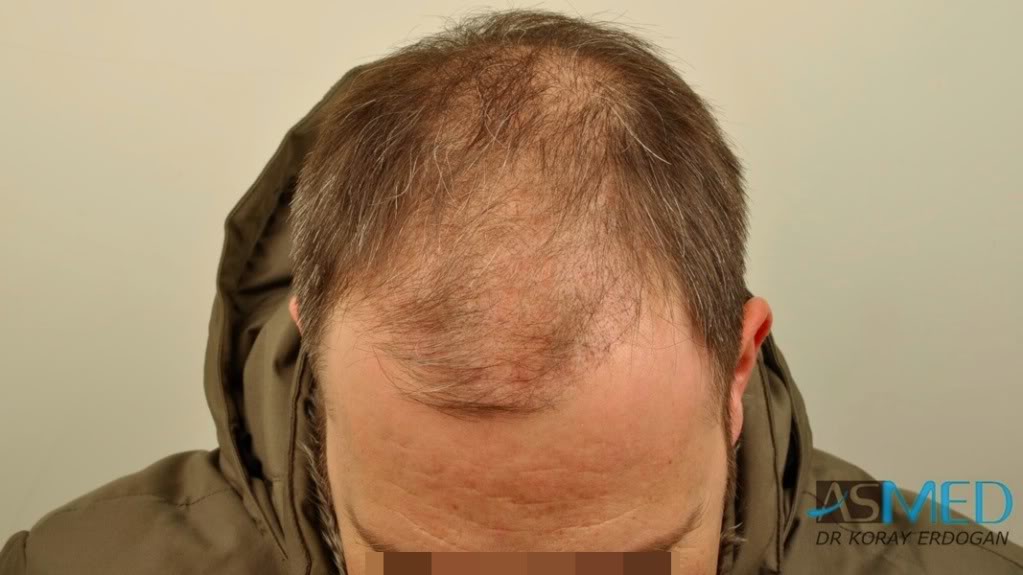 norwood4 3167-grafts-FUE-Repair file-28