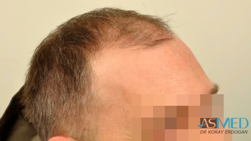 norwood4 3167-grafts-FUE-Repair file-29