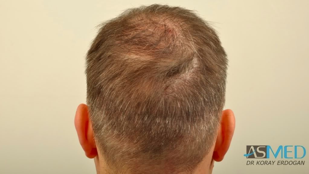 norwood4 3167-grafts-FUE-Repair file-31