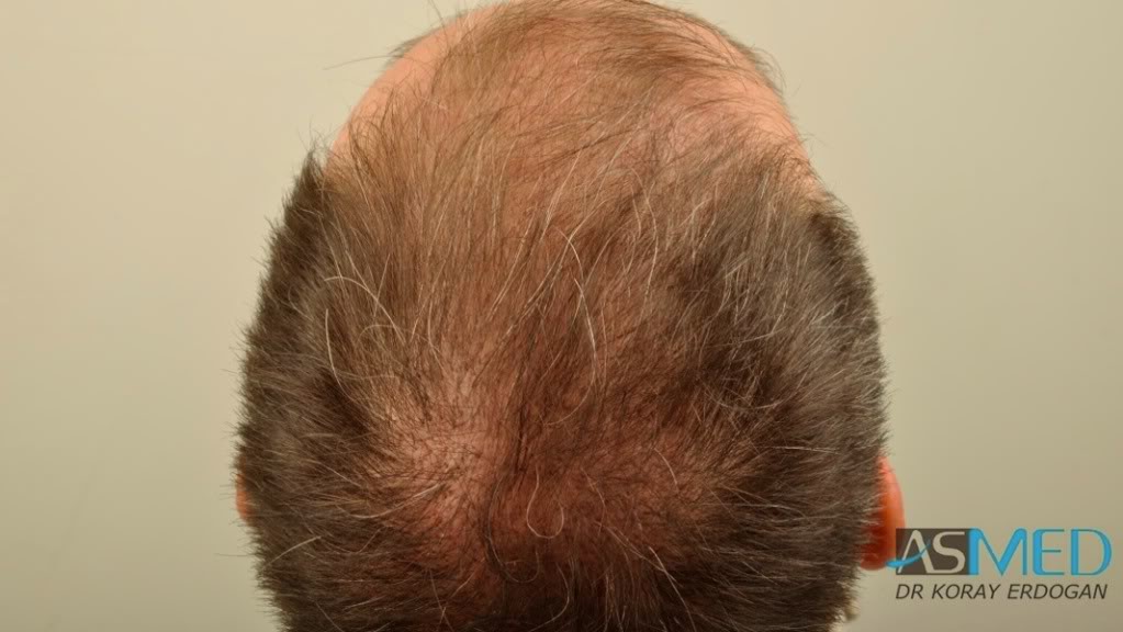 norwood4 3167-grafts-FUE-Repair file-33