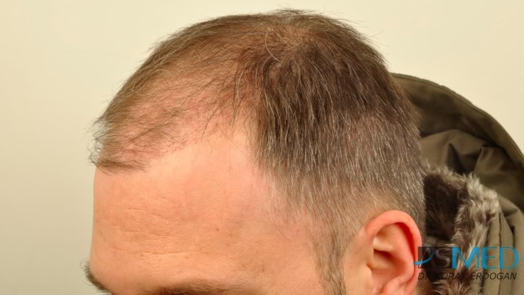norwood4 3167-grafts-FUE-Repair file-34