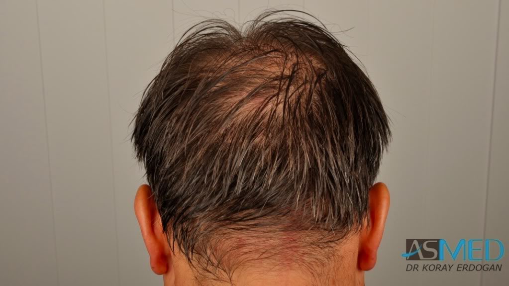 norwood4 3167-grafts-FUE-Repair file-4