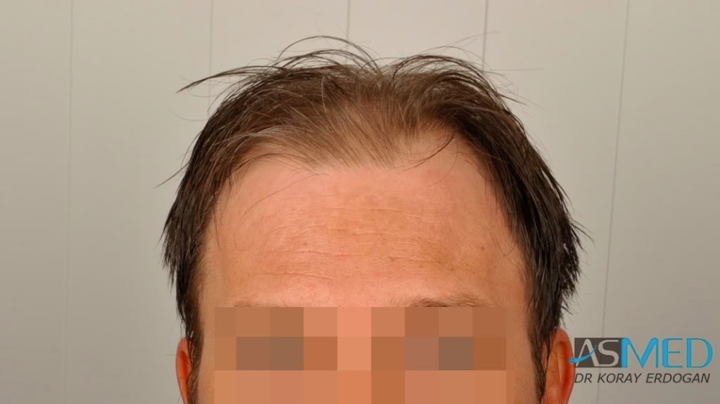 norwood4 3167-grafts-FUE-Repair file