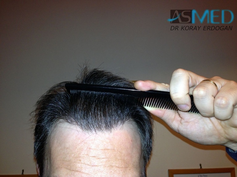 norwood4 3167-grafts-FUE-Repair file_zps190f0750