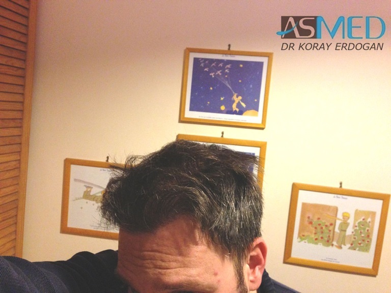 norwood4 3167-grafts-FUE-Repair file_zps299c39af