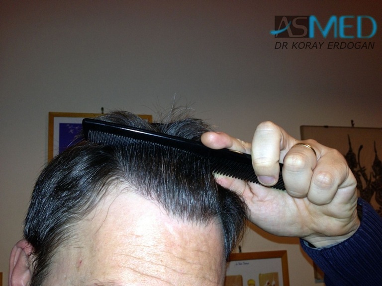 norwood4 3167-grafts-FUE-Repair file_zps325b8043